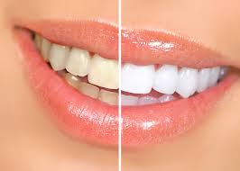 White Teeth Before and After